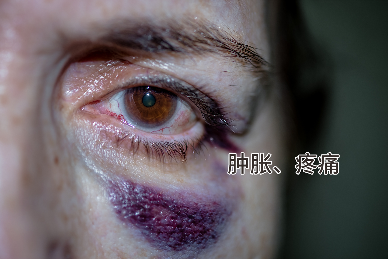 打伤肿痛图片 打伤肿痛图片搞笑