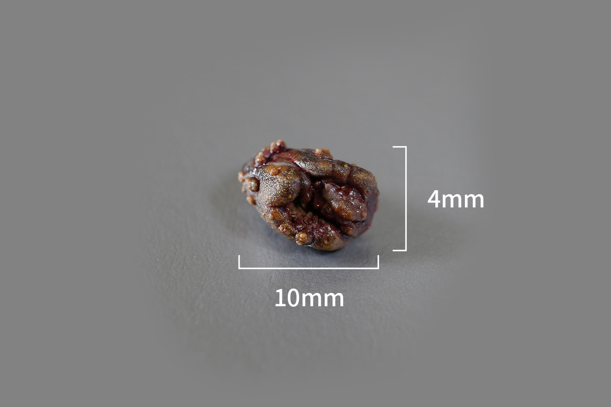 10mmx4mm的结石排出图 结石10mmx6mm是能自行排出吗