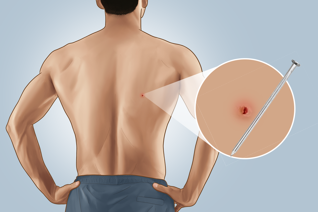 后背被钉子扎了的图片（后背被钉子扎了的图片真实）