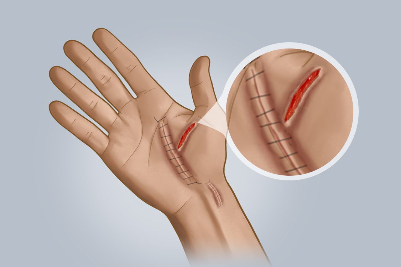 拆线太早伤口裂开图片（拆线太早伤口裂开图片）