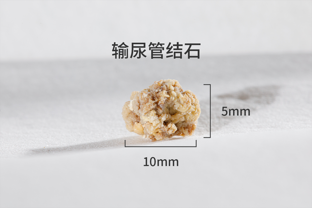 10mmx5mm的输尿管结石排出图（10mm的输尿管结石能排出来吗）