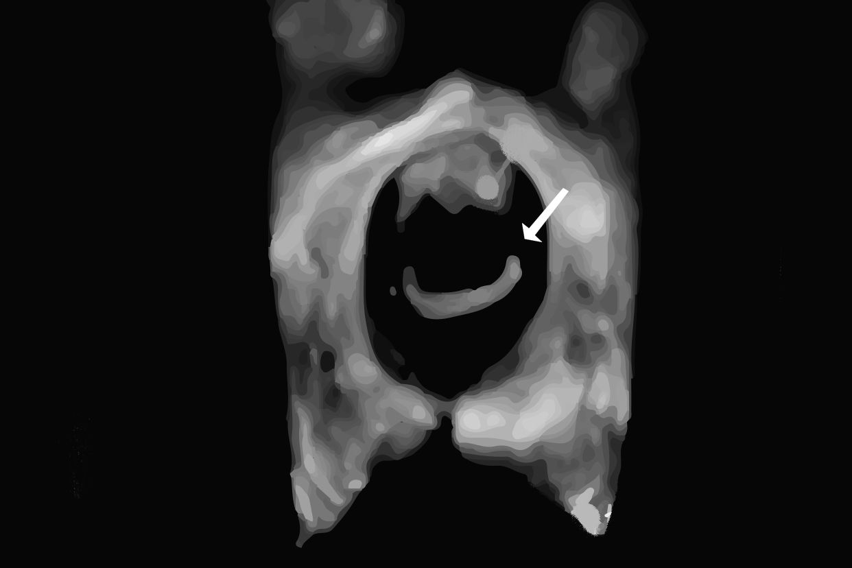 产后膀胱脱垂三度图片 产后膀胱二度脱垂怎么治疗