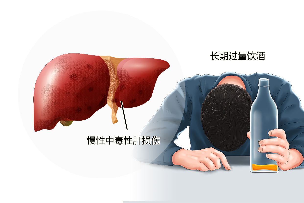 酒精肝症状图片(酒精肝的症状及表现图片)