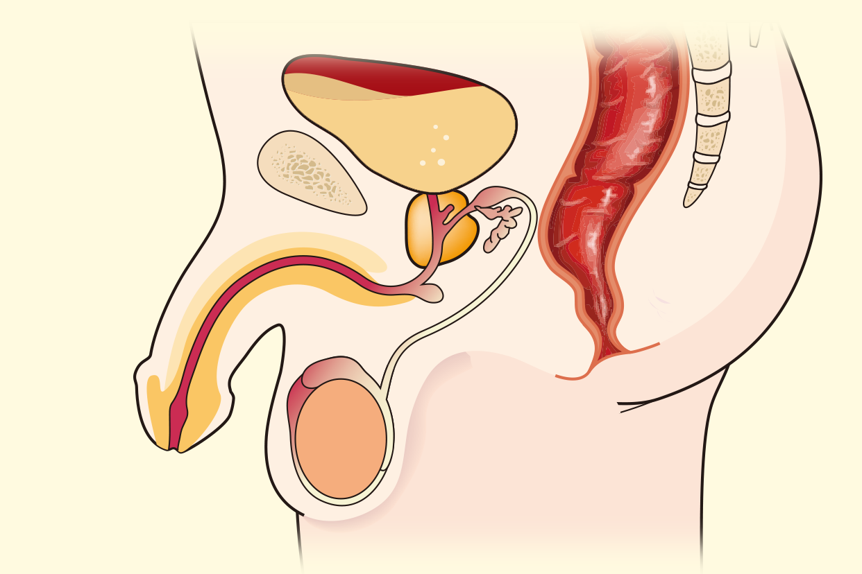 正常充盈性膀胱压力图（膀胱充盈状态示意图）
