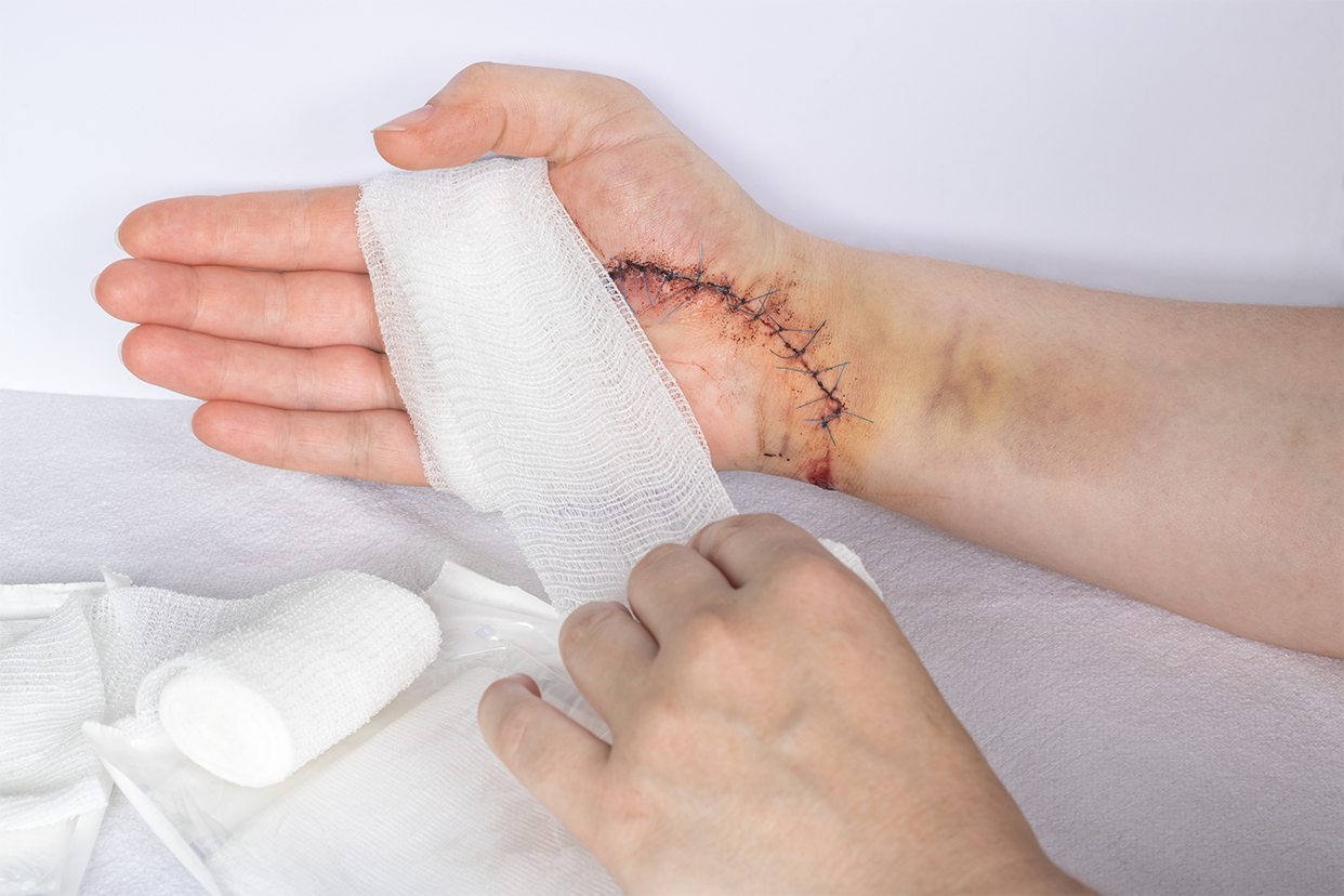 手部手术切口示意图（常见手术切口位置）