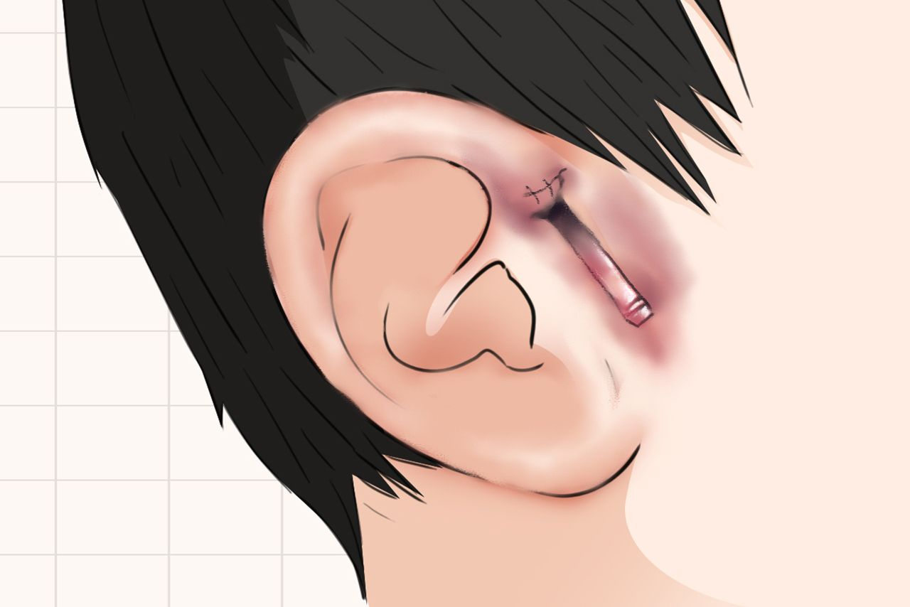 耳前瘘管引流条图片 耳前瘘管发炎引流后伤口图片