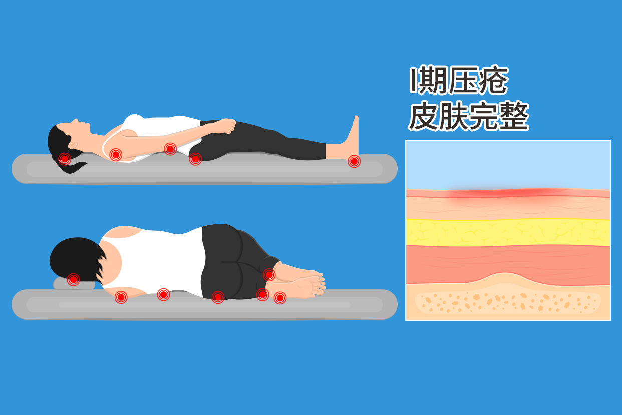 压疮淤血红润期的图片（压疮瘀血红润期的图片）