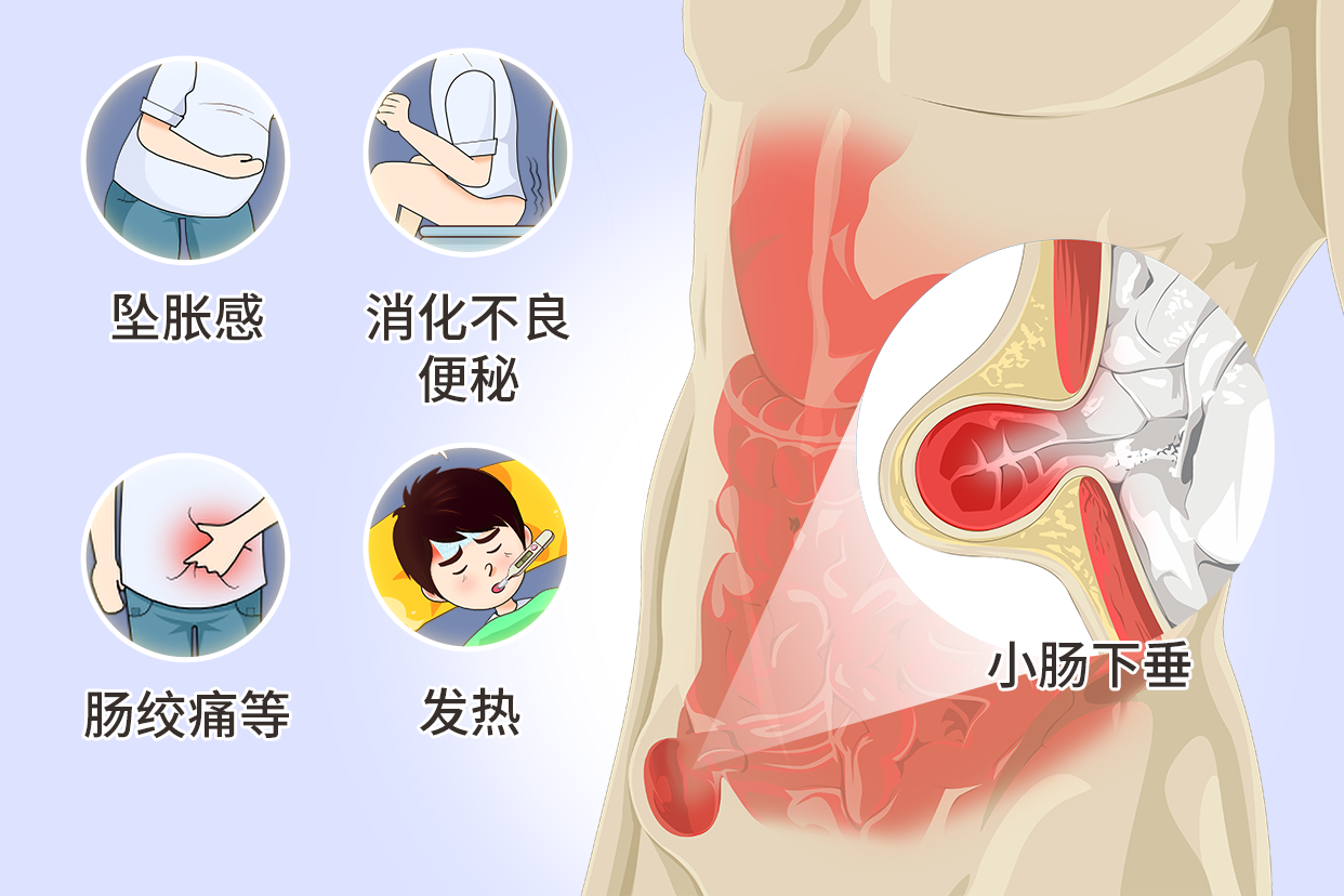 什么是小肠下垂图片