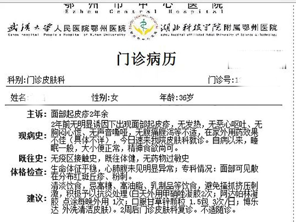 面部痤疮影响美观，外用甲硝唑凝胶可以改善