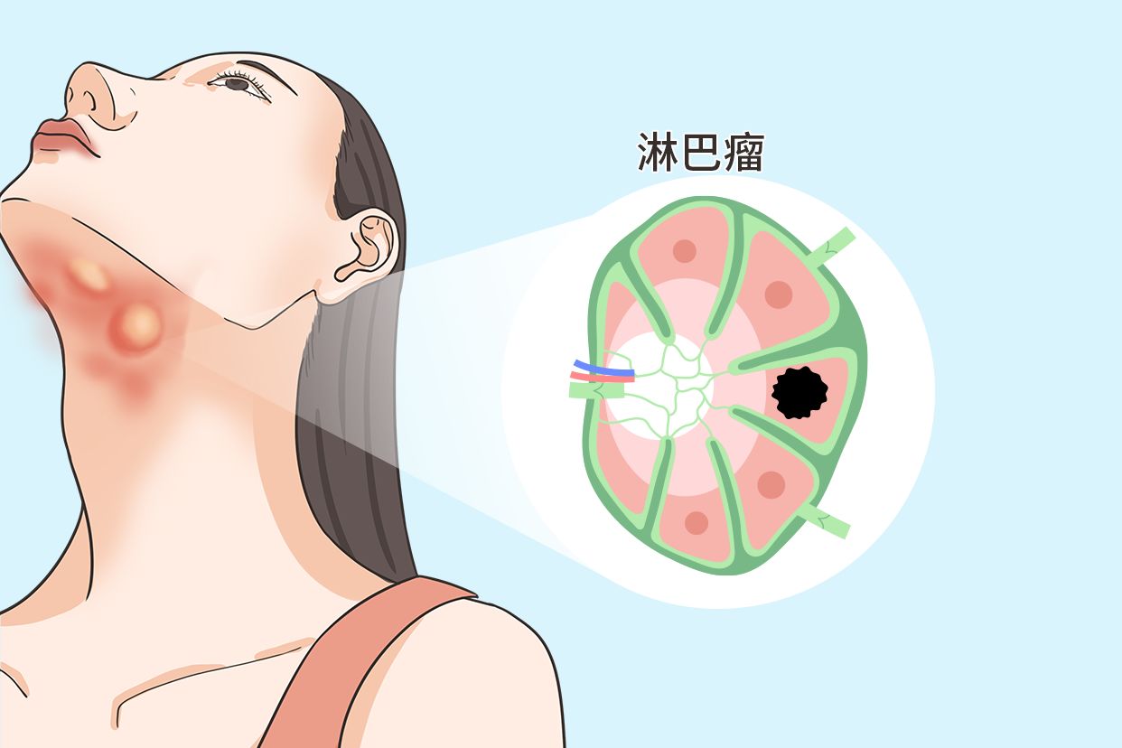 颌下淋巴瘤的图片（下颌淋巴肿瘤的图片）