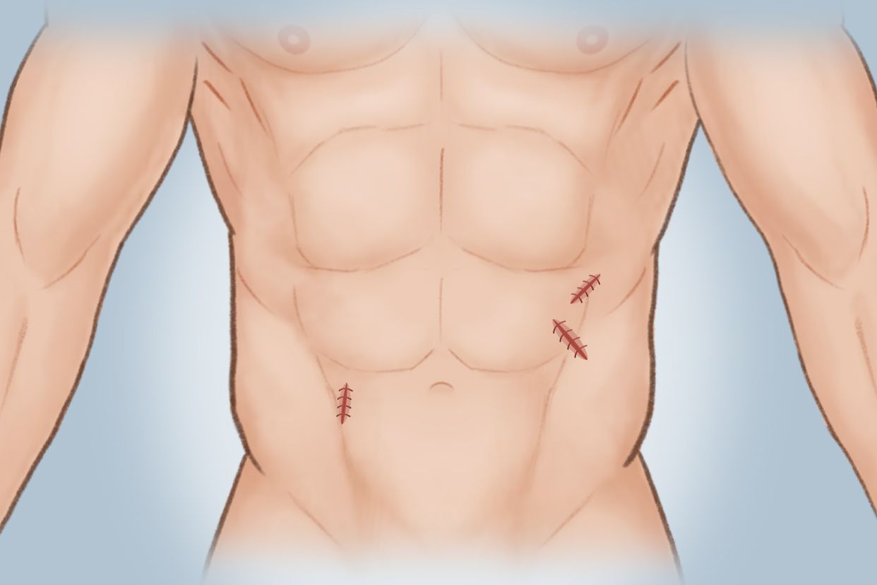 腹部补片手术后图片（腹部手术补片是什么）