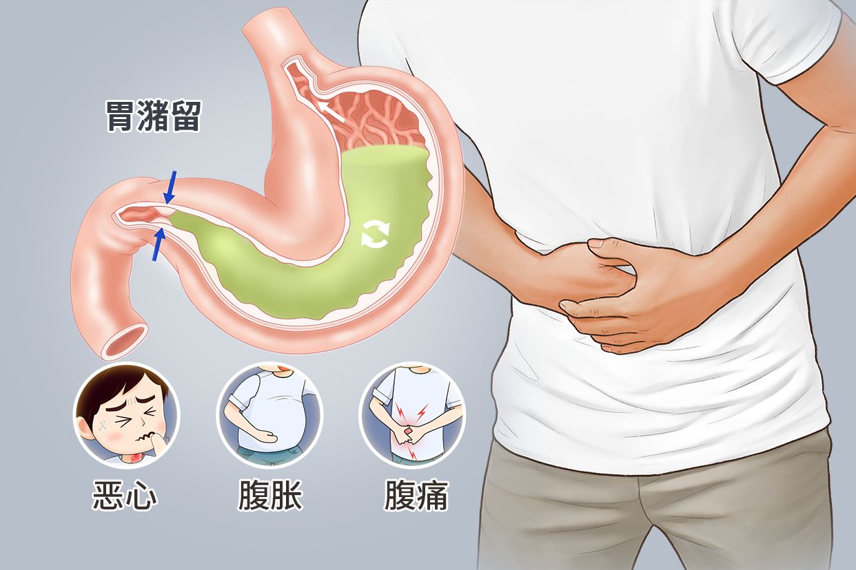 胃潴留图片 胃潴留图片照片