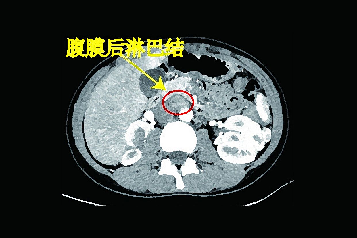 腹膜后淋巴结ct图像（腹膜后淋巴结ct图片）