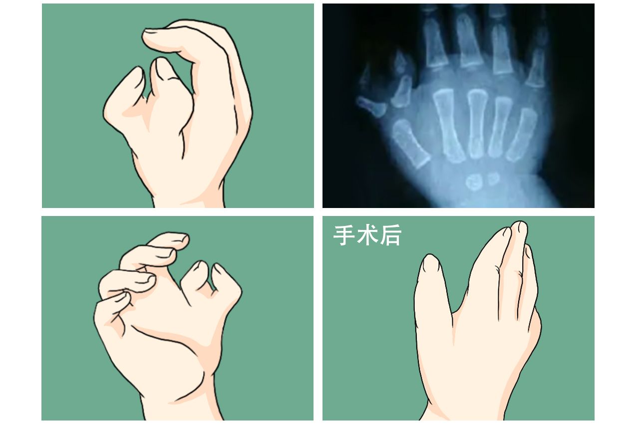 成人蟹钳指手术后图片（蟹钳手指可以手术吗）