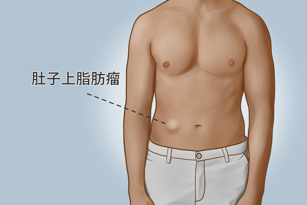 腹部多发脂肪瘤图片 腹部多发脂肪瘤图片大全