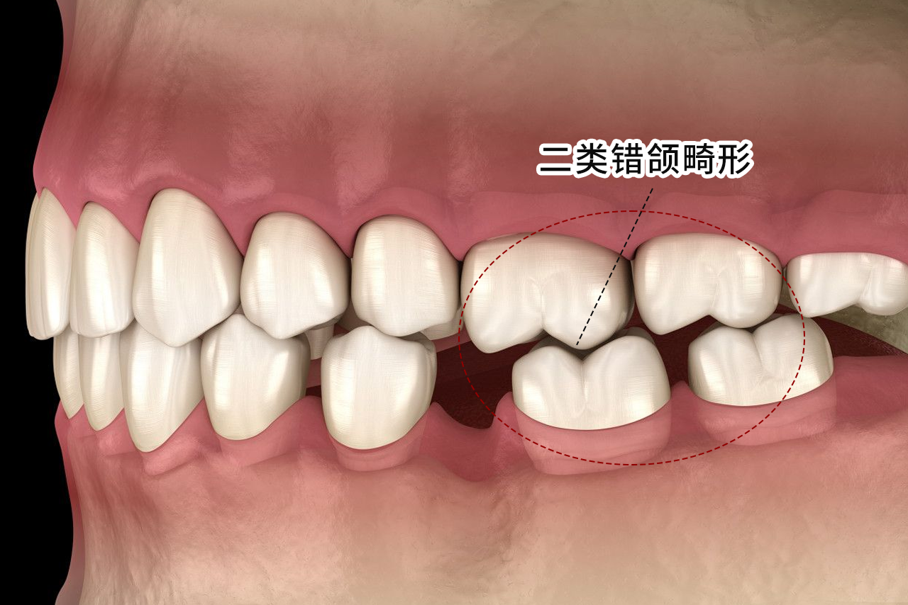 二类错颌畸形图片 一类错颌畸形图片