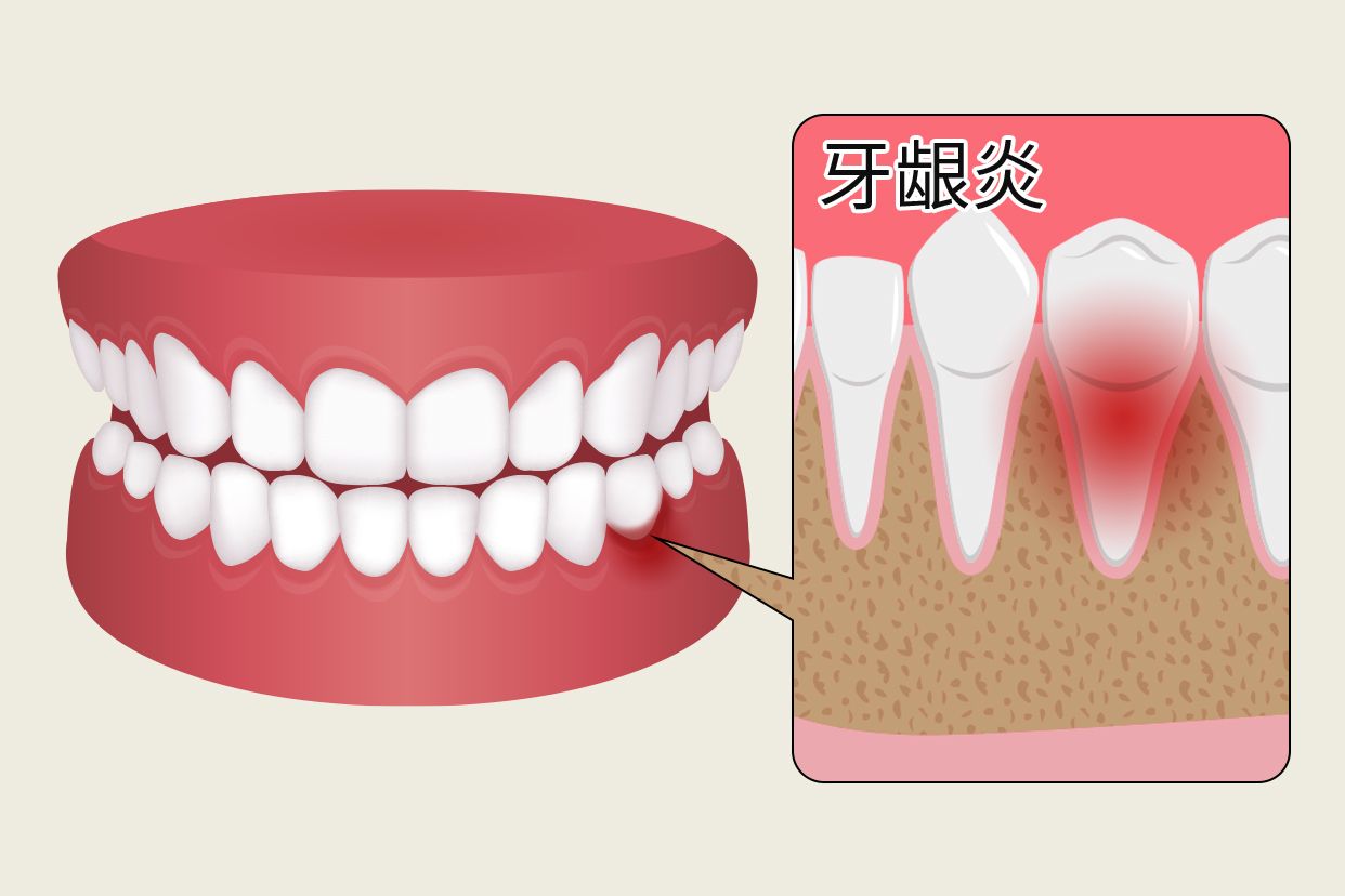 牙龈炎早期症状图片（牙龈炎早期症状图片大全）