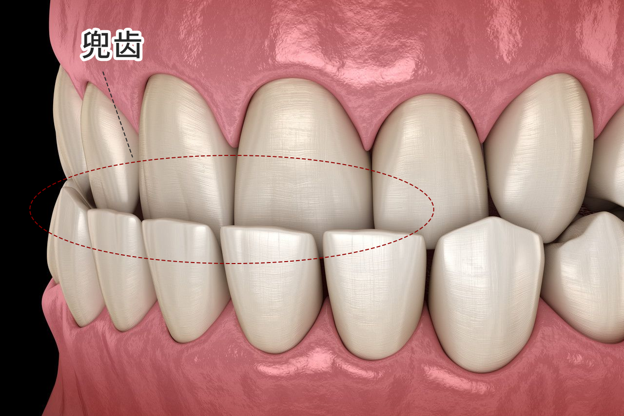 轻微兜齿图片 轻微兜兜齿