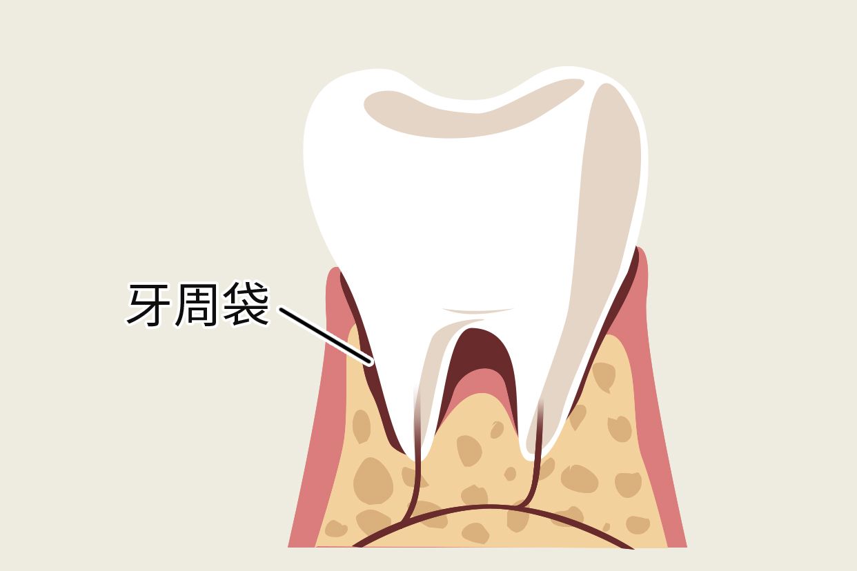 什么是牙周袋及图片 牙周袋外观图片