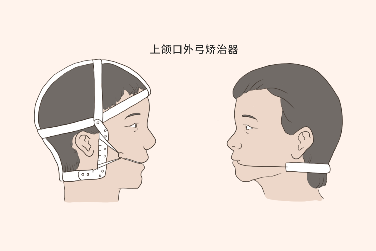 上颌口外弓矫治器图片（上颌口外弓矫治器图片）