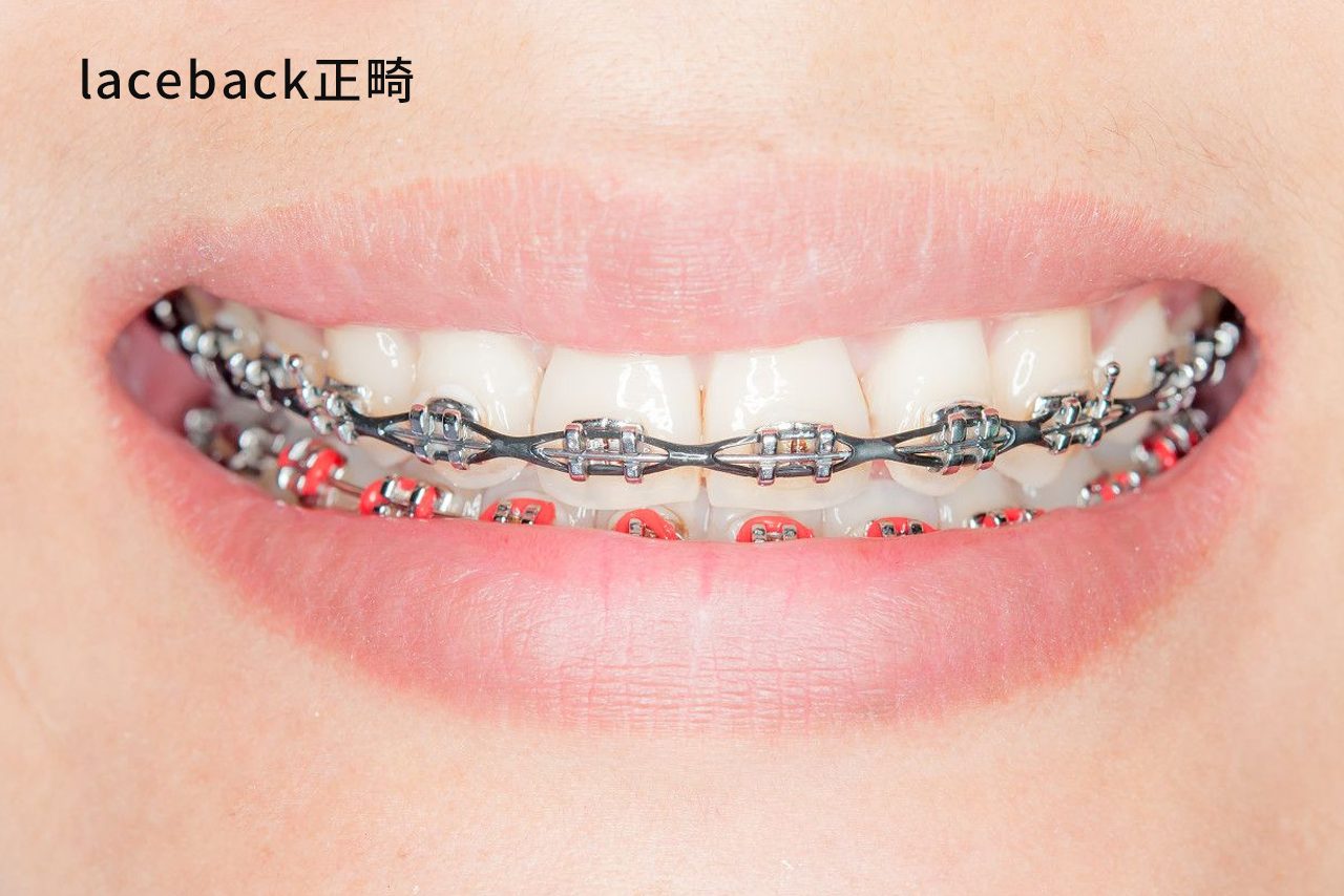 laceback正畸示范图 正畸laceback图片