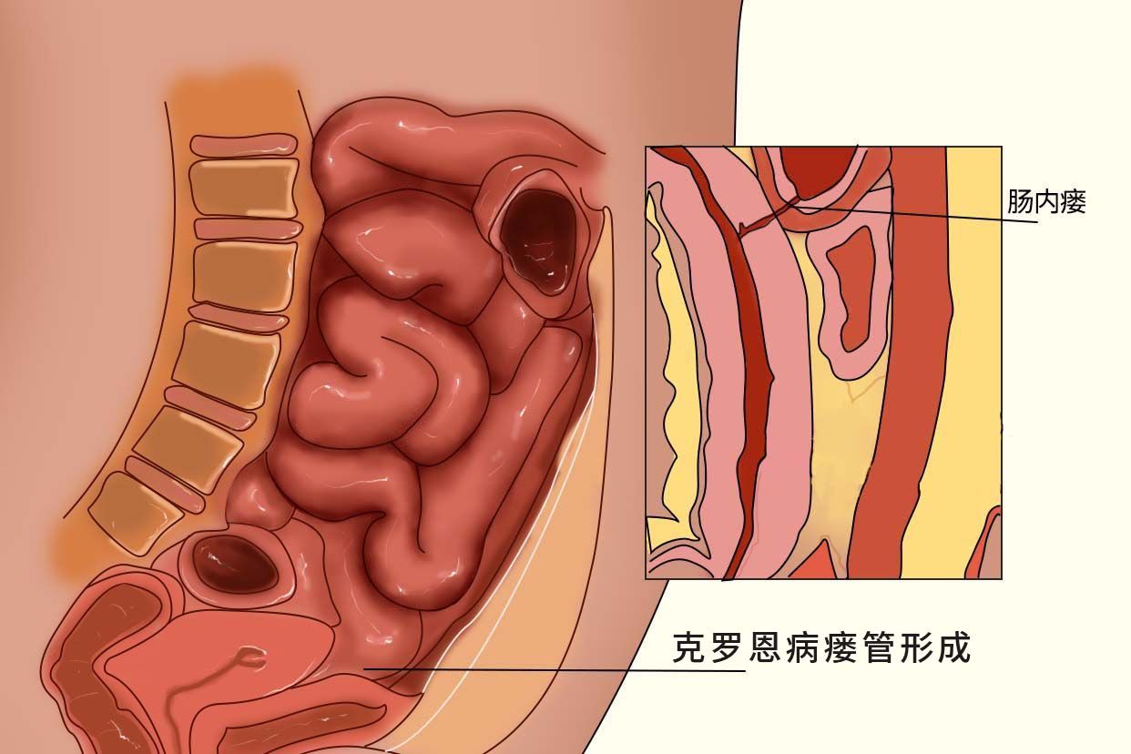 克罗恩病瘘管形成图片（克罗恩病内瘘）