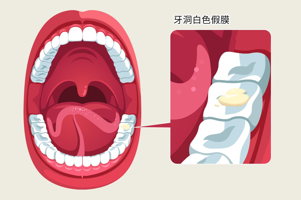 牙洞白色假膜图片（拔智齿后的白色假膜图）