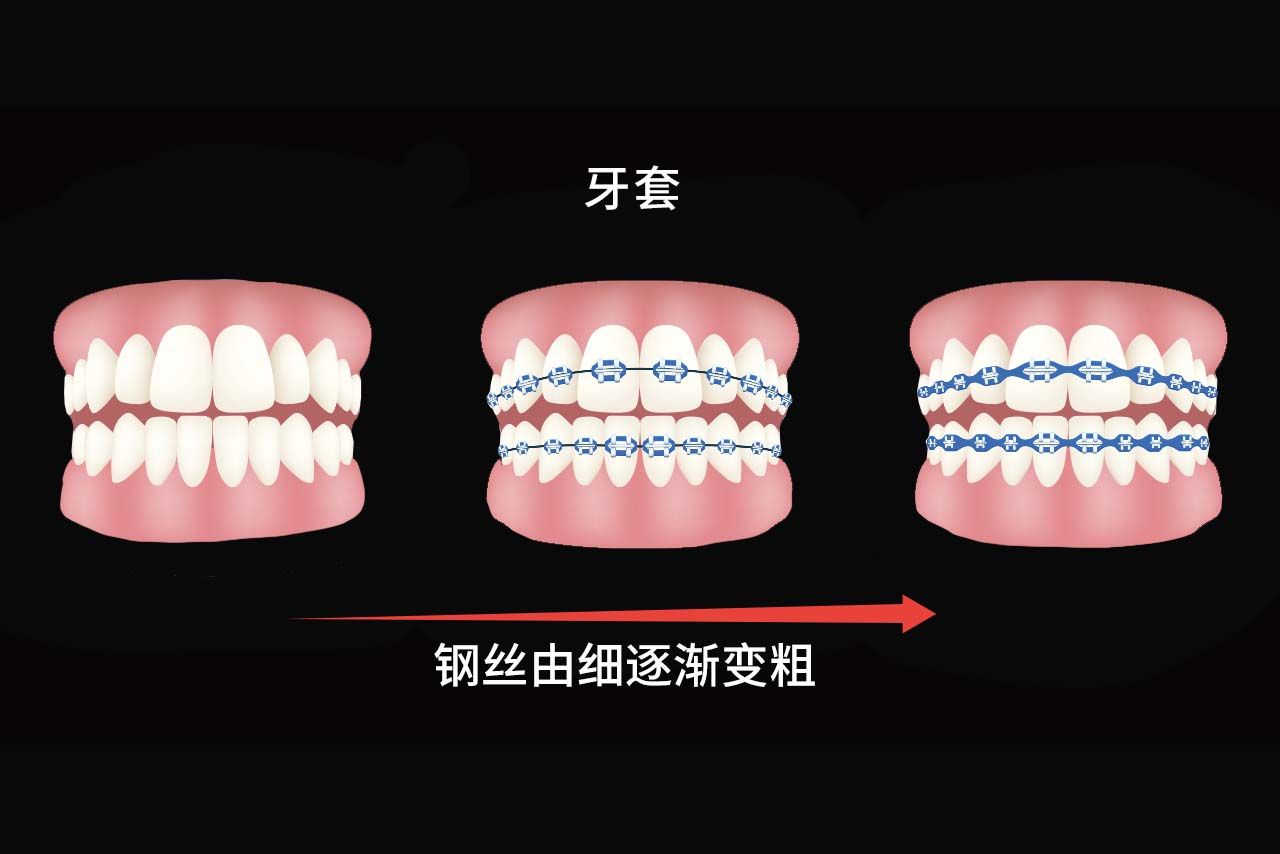 牙套换钢丝粗细顺序图片 牙套换钢丝粗细顺序图片对比