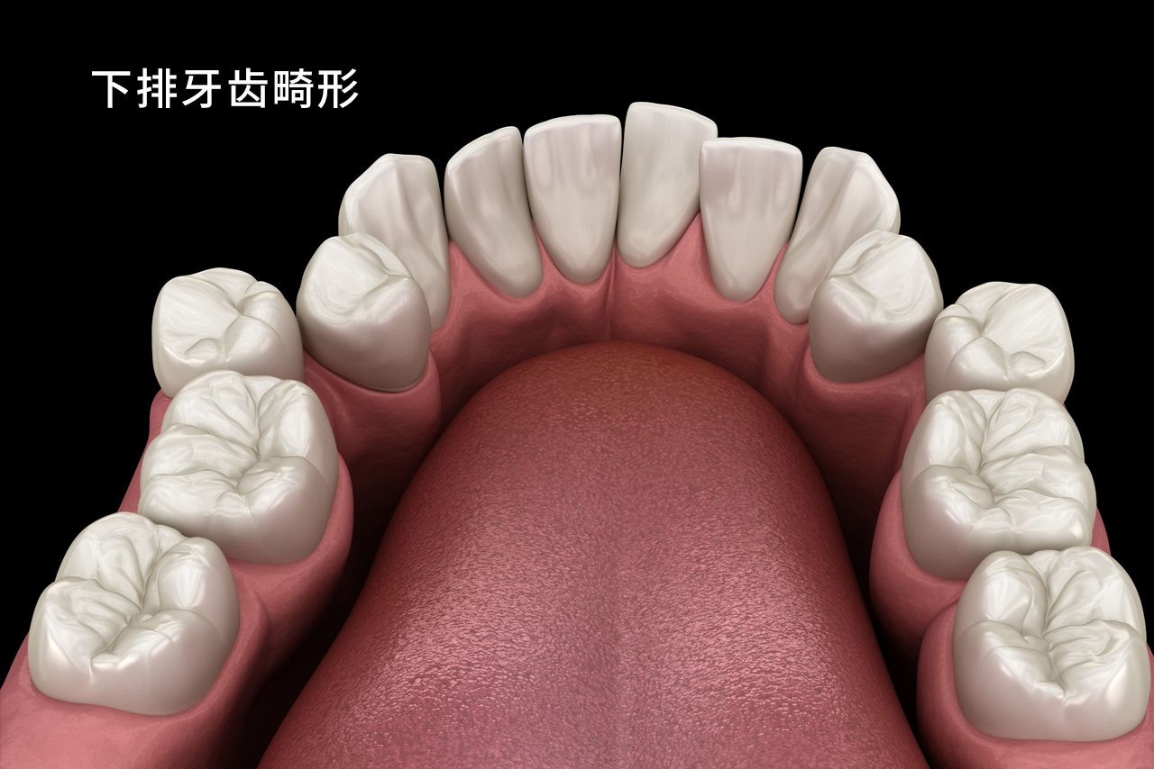 下排牙齿畸形图 下排牙齿畸形图片大全