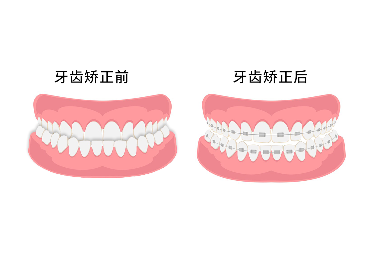 反颌牙齿矫正过程图片（反颌牙齿矫正过程图片视频）