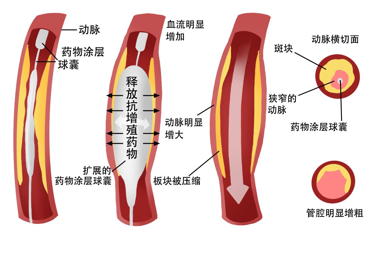 药物球囊和放置过程图 药物球囊操作流程