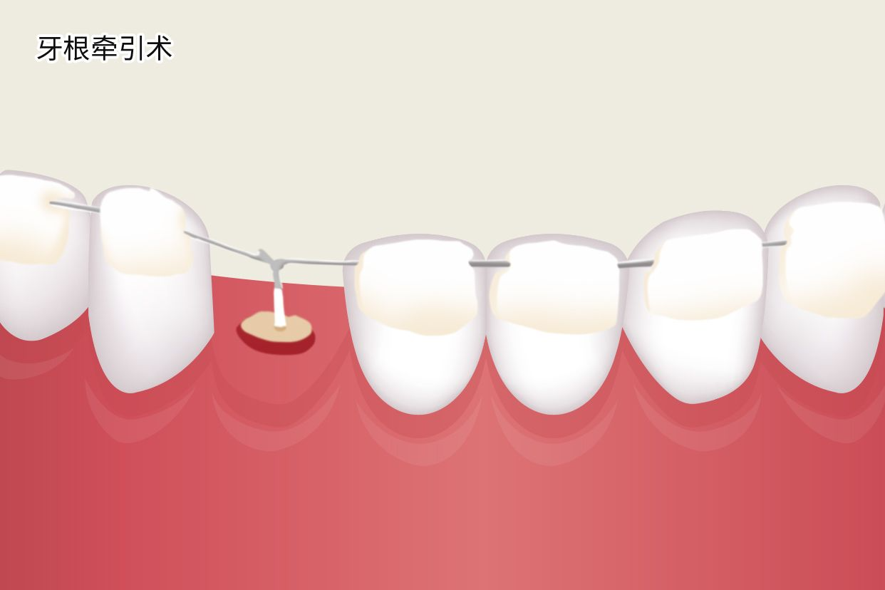 牙根牵引术图解（牙根牵引术图解大全）