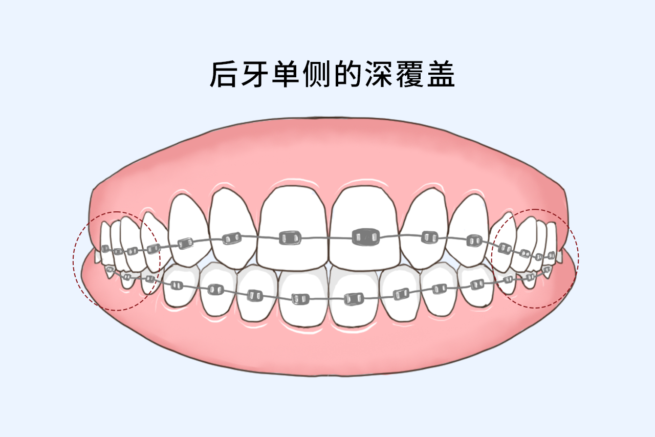 后牙单侧的深覆盖如何矫正图片 后牙单侧的深覆盖如何矫正图片视频