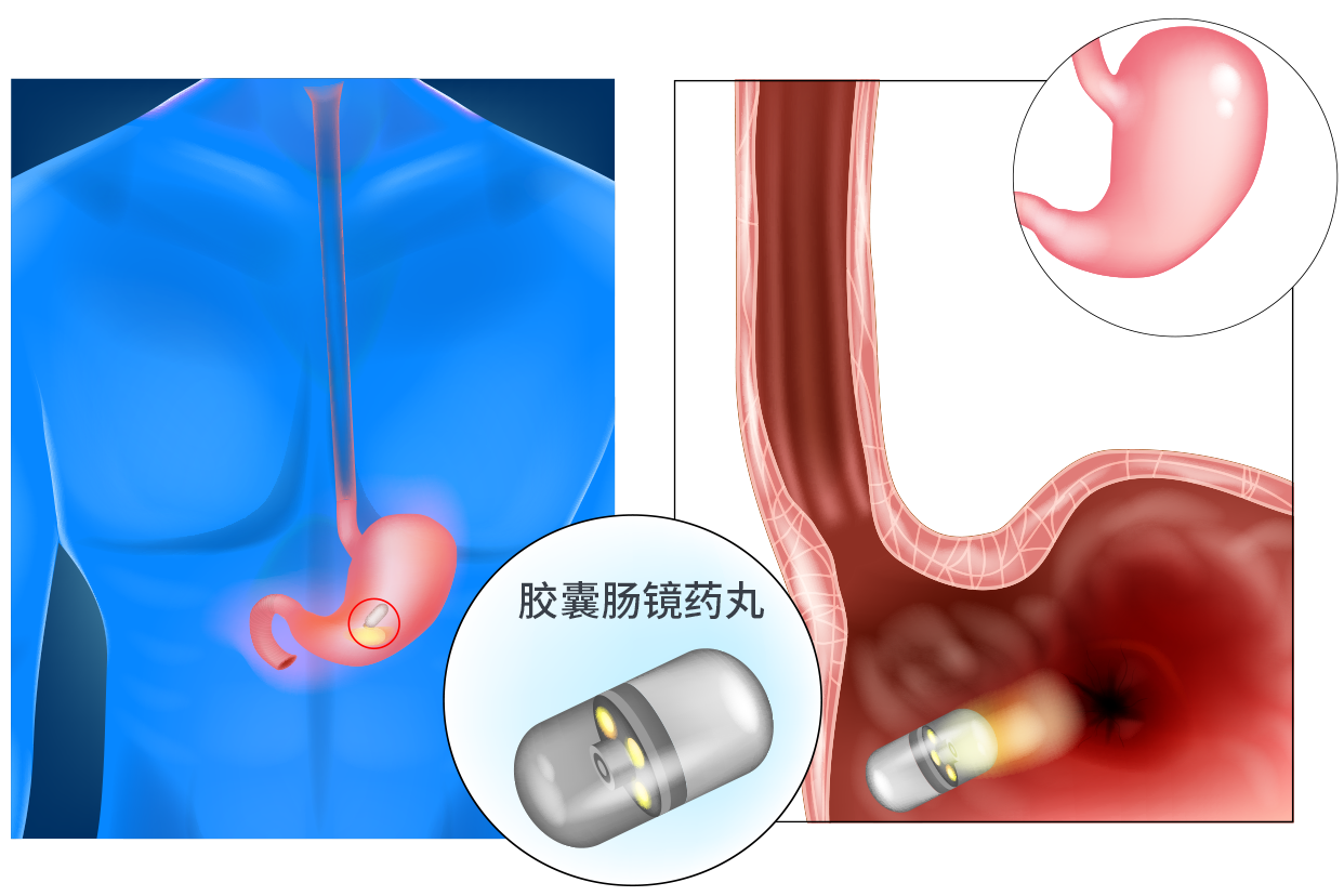 胶囊肠镜药丸图片 胶囊肠镜药丸图片大全