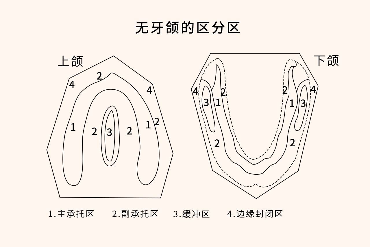 全口义齿无牙颌分区图（全口义齿无牙颌分区图示）