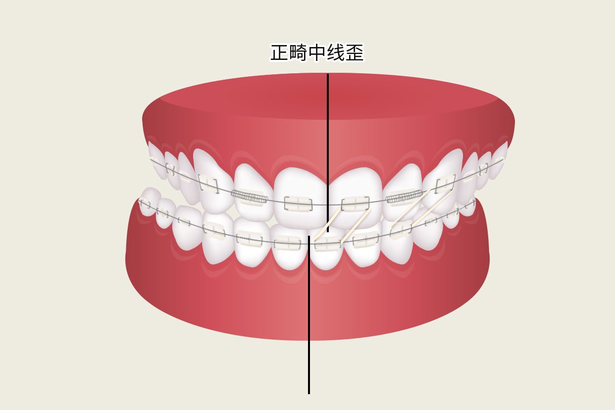 正畸中线歪如何牵引示意图 中线偏斜正畸怎么牵引