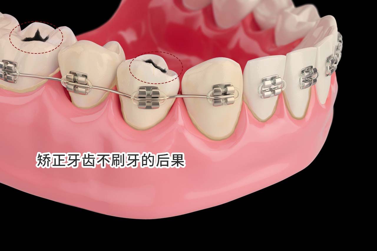 矫正牙齿不刷牙的后果图片 矫正牙齿不刷牙的后果图片真实