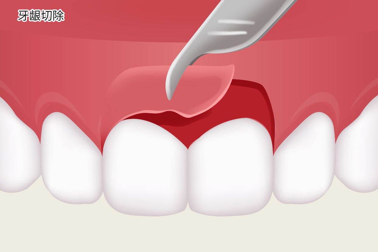 牙龈切掉能长吗图片 切牙龈会长出来吗