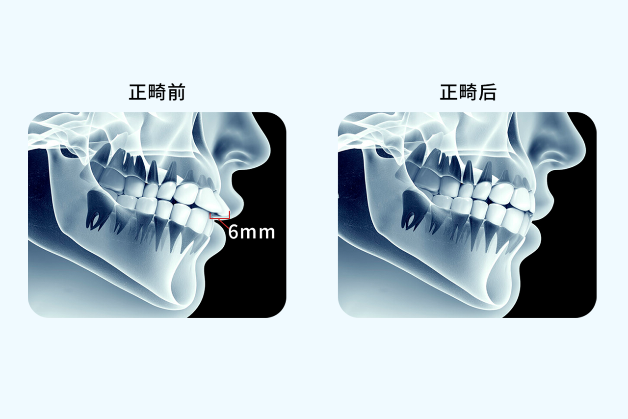 正畸内收6mm效果图（正畸内收3mm效果）