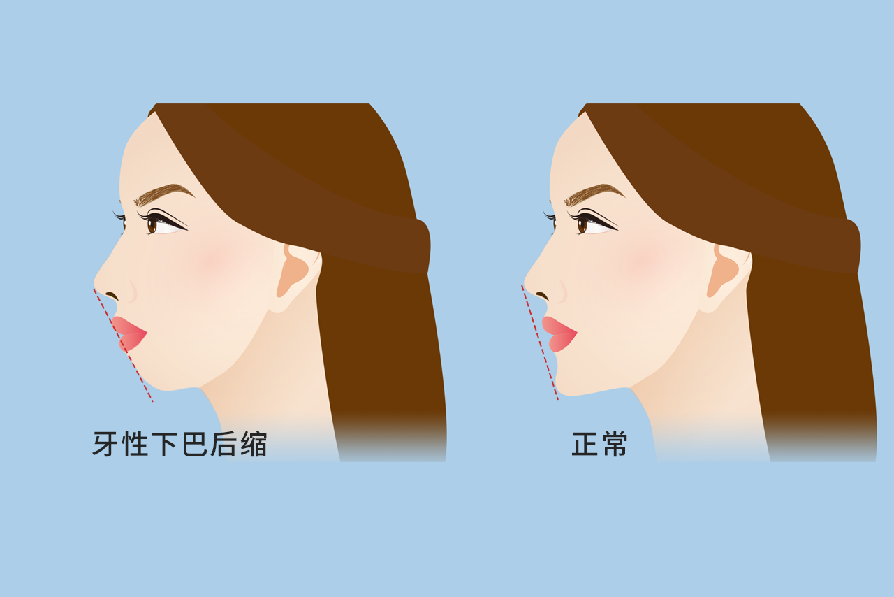 牙性下巴后缩图片 龅牙下巴后缩图片