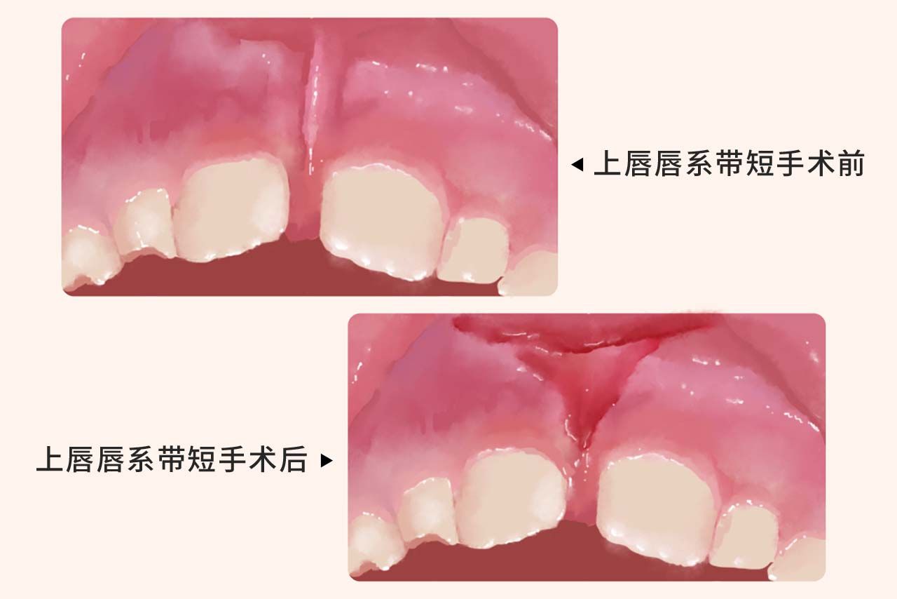 上唇唇系带短手术后图 唇系带延长手术后图