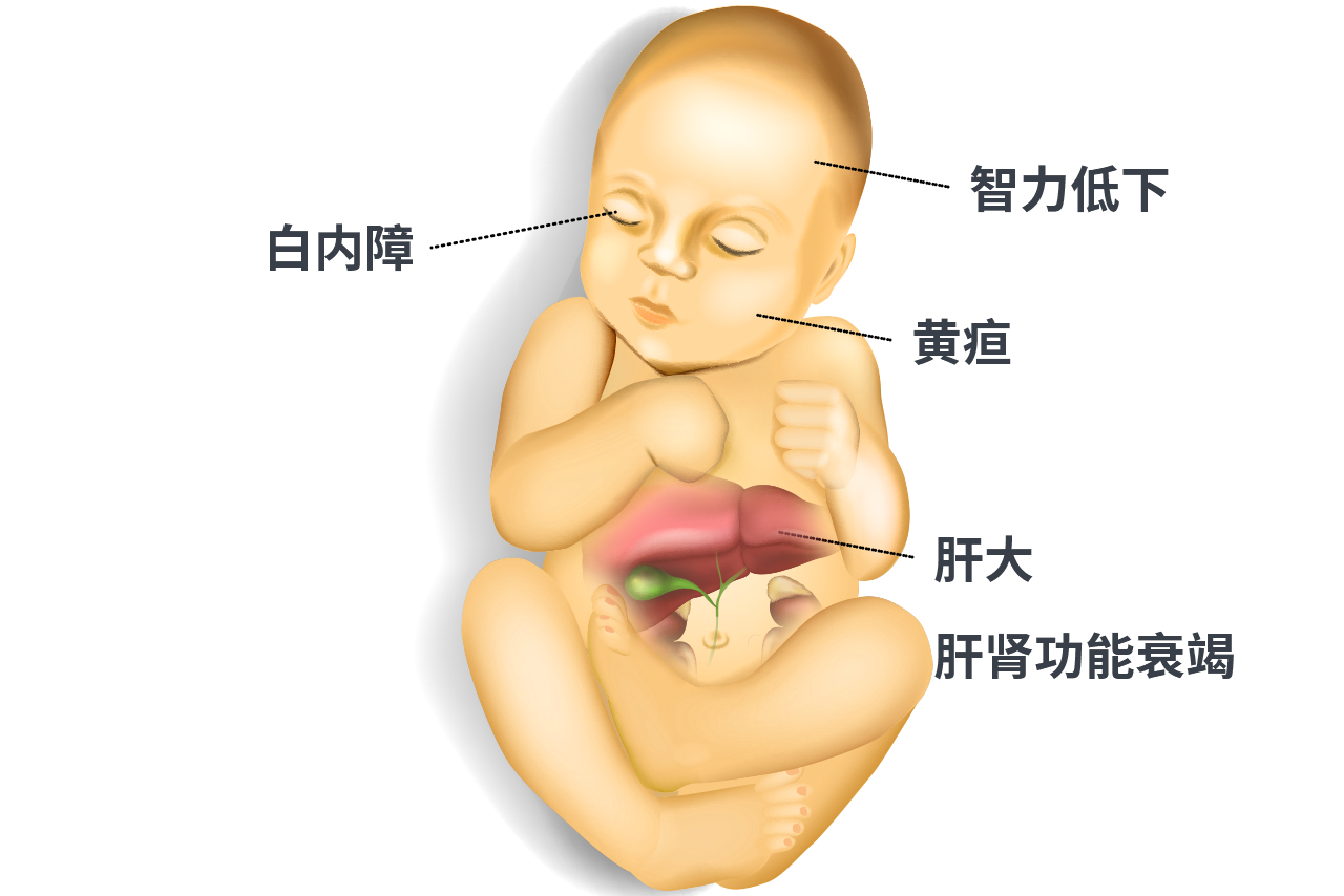 半乳糖血症患者图片 半乳糖血症儿童图片