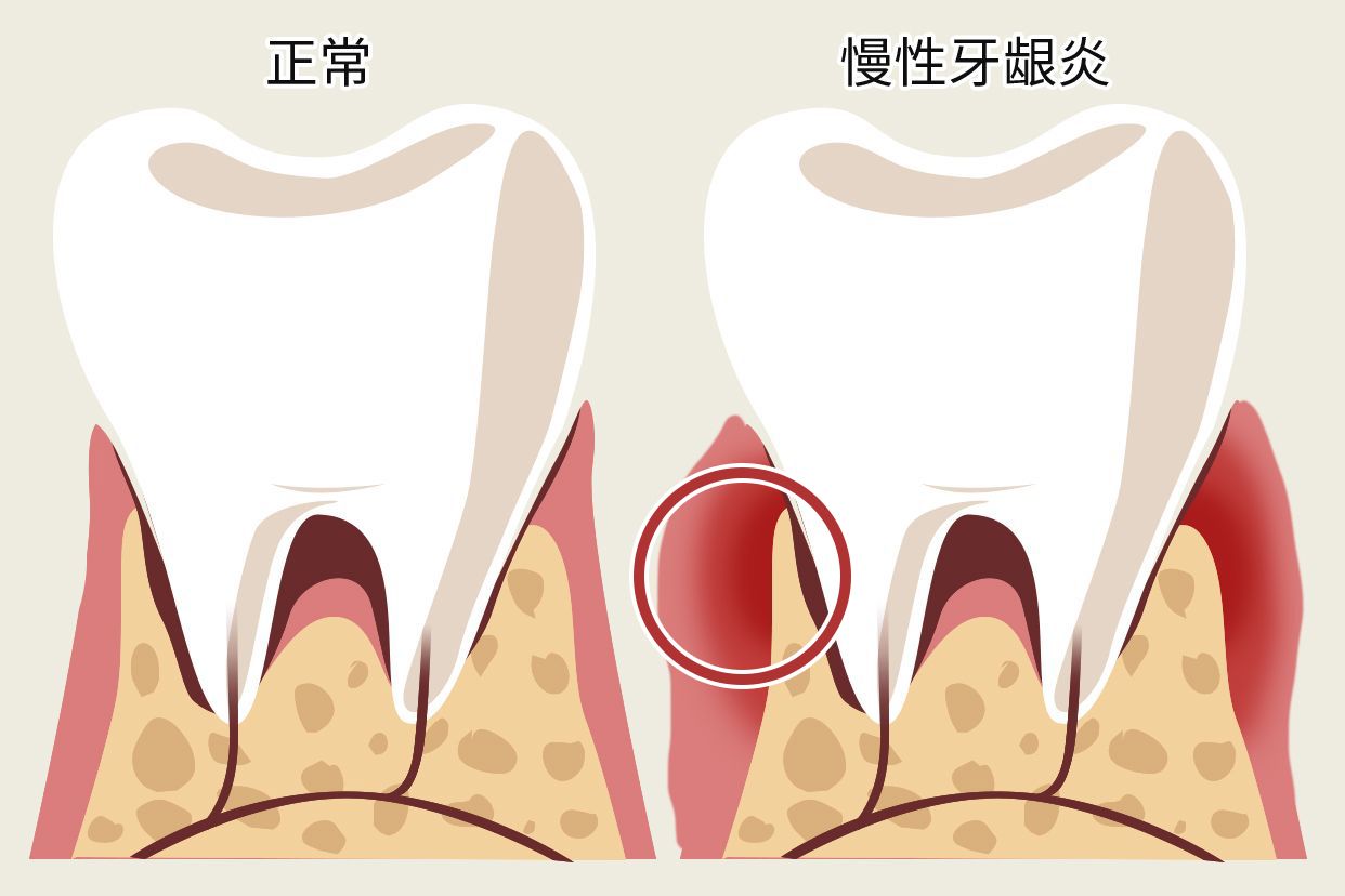 慢性牙龈炎图片（慢性牙龈炎图片大全）