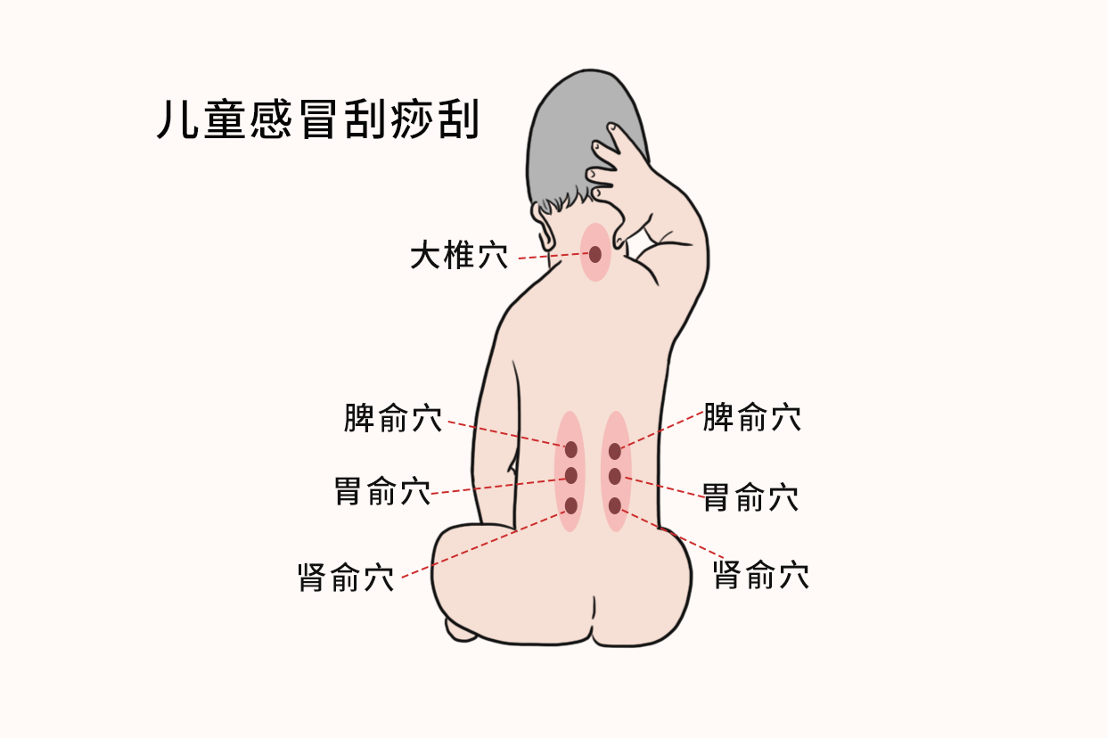 儿童感冒刮痧刮哪里图解 小儿感冒刮痧的方法示意图