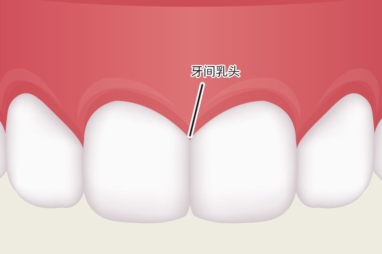 牙龈乳头图片（牙龈人乳头瘤图片）