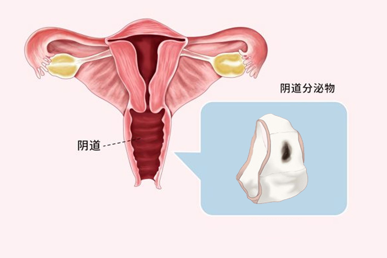 阴道里怎么会有黑色的分泌物图片