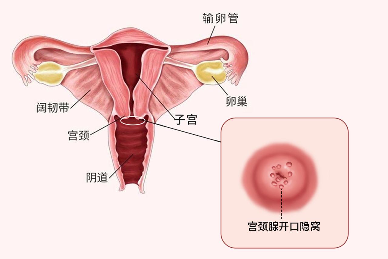 宫颈腺开口隐窝图片 宫颈腺开口隐窝怎么治疗