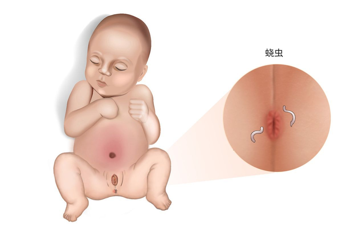 小孩肛周蛲虫图片 宝宝肛周蛲虫的症状