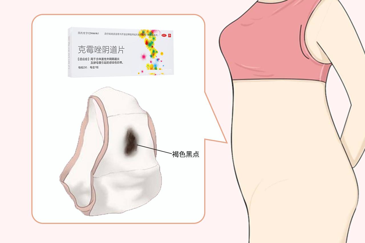 用了克霉唑排出褐色黑点正常吗图片 用了克霉唑排出来的东西有点带红,什么情况