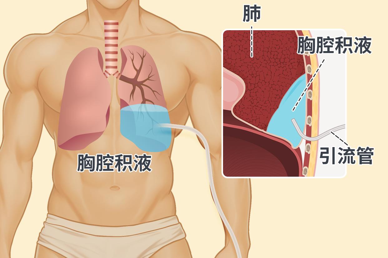 胸膜炎伤口引流管的位置图片 胸膜炎引流疼吗